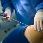 a person partway through a liposuction procedure