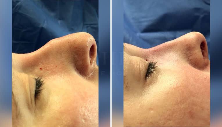 rhinoplasty before and after uk