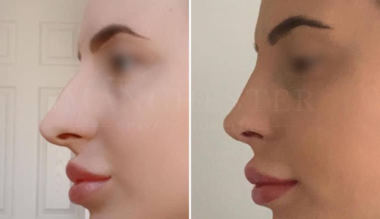 rhinoplasty surgery before and after