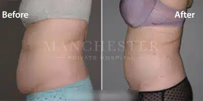 stomach vaser liposuction before and after