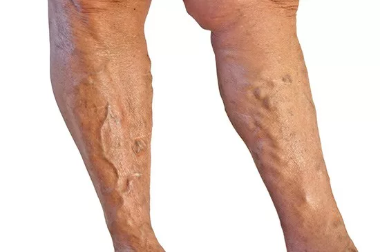 Varicose Vein Types - Liverpool Varicose Veins Clinic