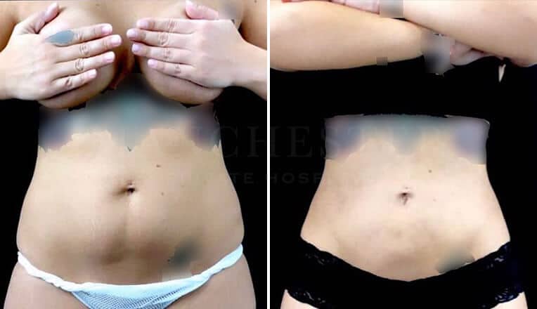 tummy tuck before and after