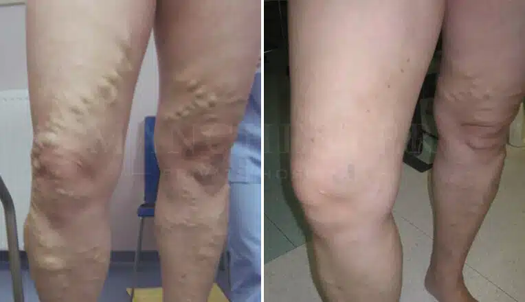 varicose vein removal before and after