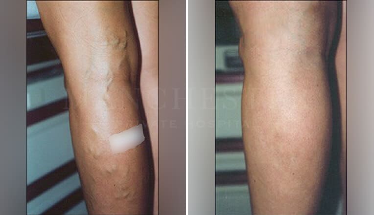 varicose veins before and after surgery
