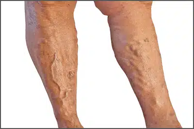 varicose-veins