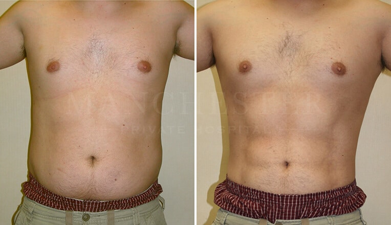 vaser 4d liposuction before and after