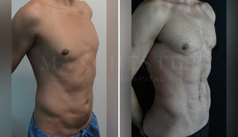 vaser 4d liposuction before and after