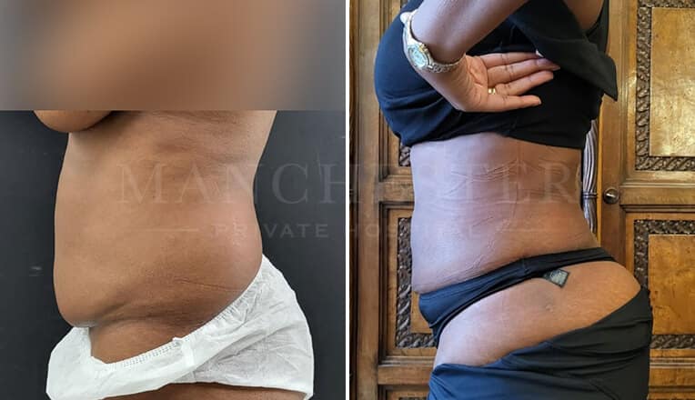 vaser lipo before and after stomach by dr kam singh