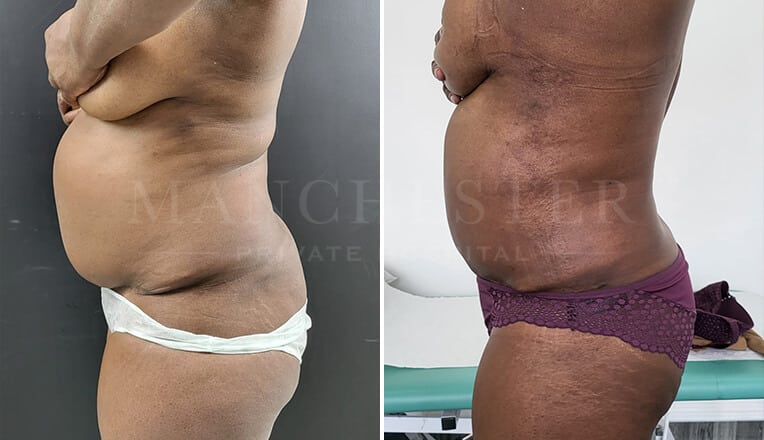 vaser lipo before and after stomach by dr kam singh