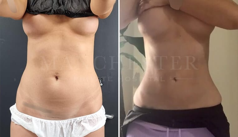 vaser lipo before and after stomach by mr fiore-1