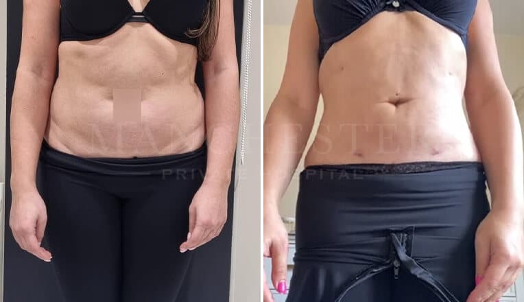 vaser lipo before and after stomach by mr fiore
