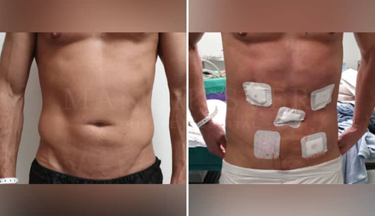 vaser lipo high definition before and after