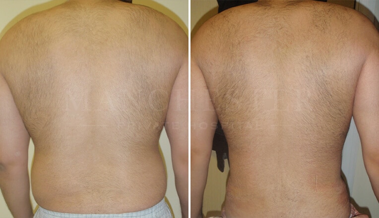 vaser lipo male before and after
