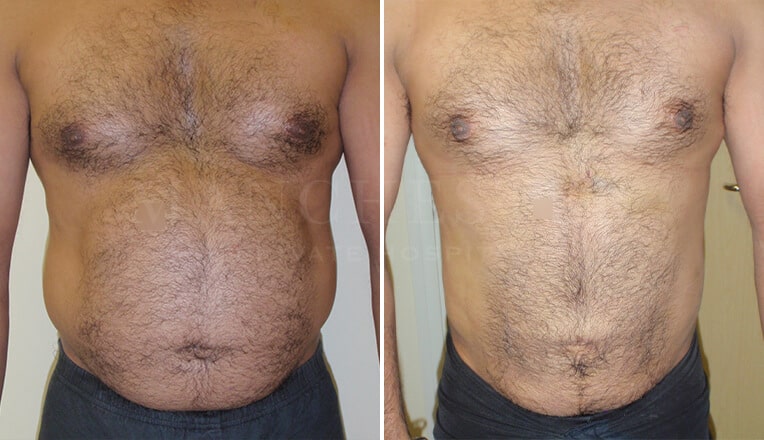 vaser lipo male before and after