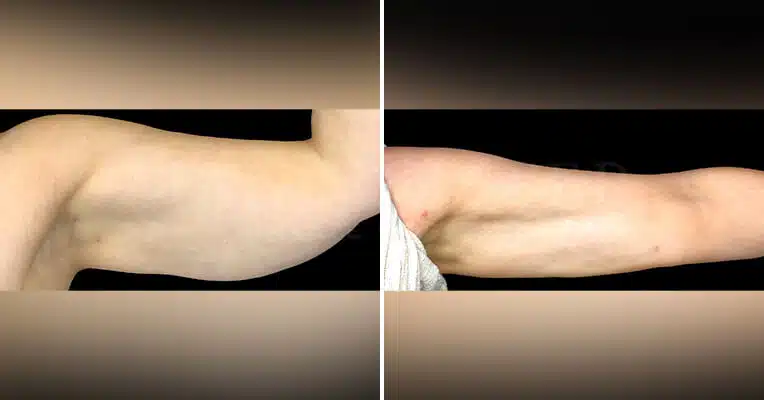 vaser lipo on arms before and after