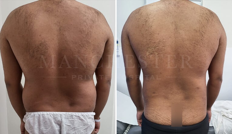 vaser liposuction before and after by dr kam singh