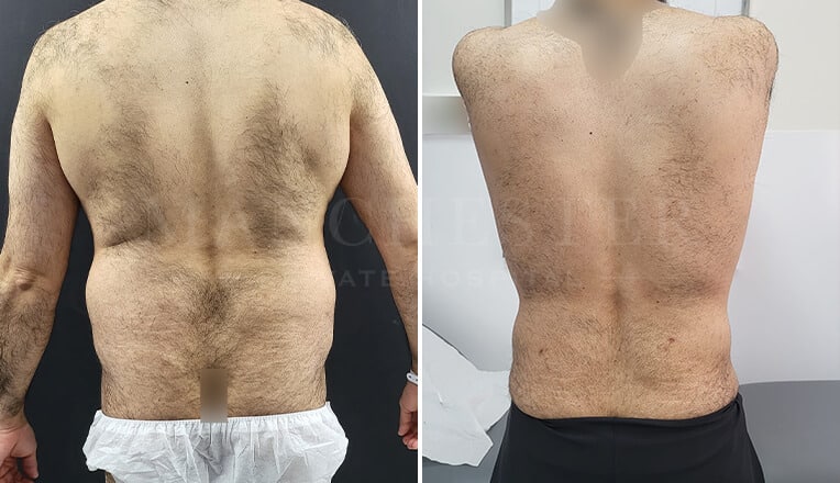 vaser liposuction before and after by dr kam singh