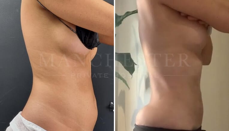 vaser liposuction before and after by mr fiore 1