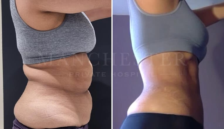 vaser liposuction before and after by mr fiore-3