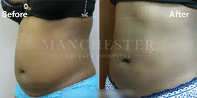 vaser liposuction before and after
