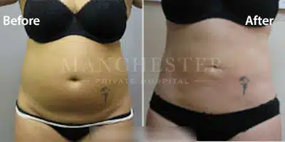 vaser liposuction before and after