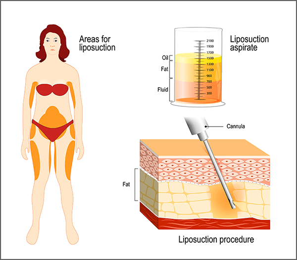 vaser liposuction procedure