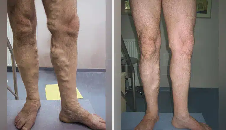 vericose vein before and after