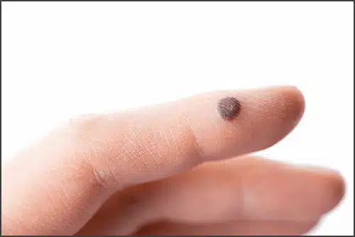 Wart Removal In Manchester