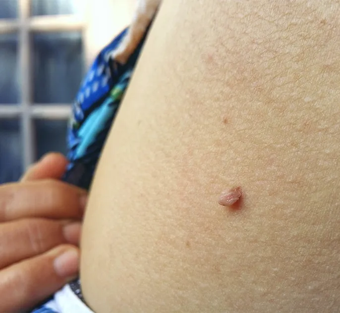 Skin Tag Removal In Manchester