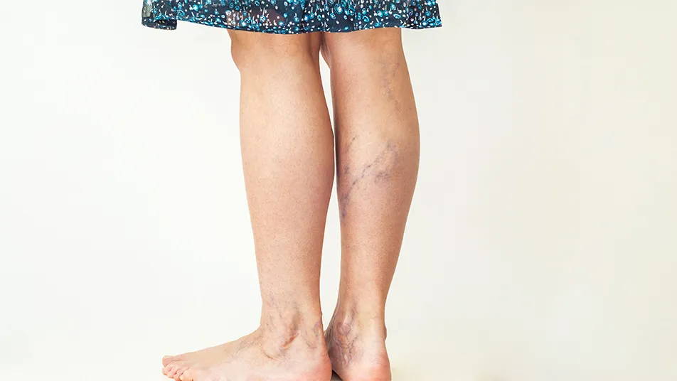 varicose vein removal manchester