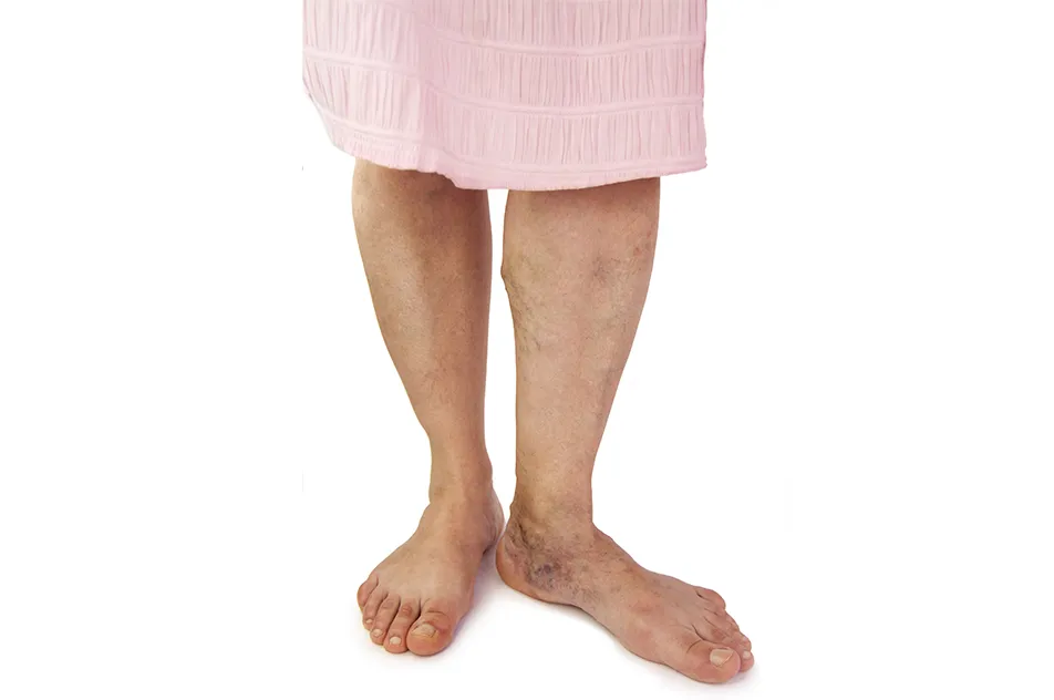 Varicose Veins Before And After Gallery