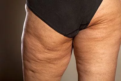 Lipoedema  Why You Should Be Taken it More Seriously