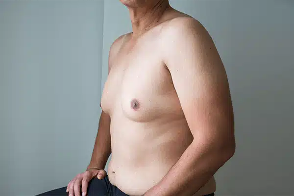 gynaecomastia