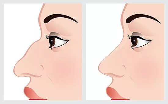 rhinoplasty