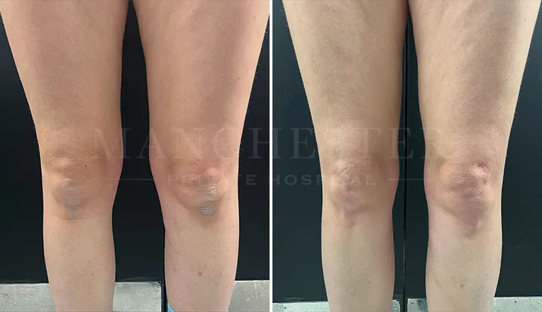 thigh vaser liposuction before and after-1