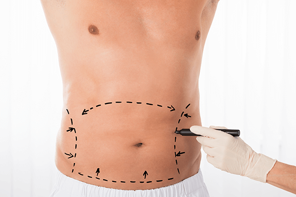 tummy tuck manchester