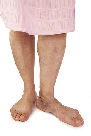 6 Things to Know About Varicose Veins