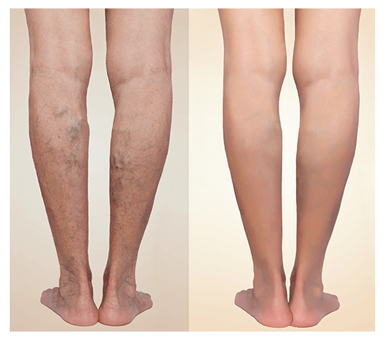 varicose veins: Are you 6-feet tall? Watch out for varicose veins - The  Economic Times