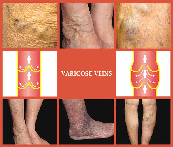 varicose veins removal manchester