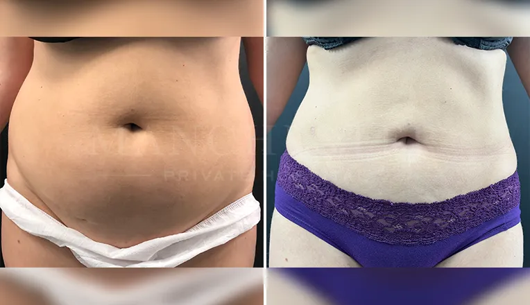 vaser liposuction before and after-1