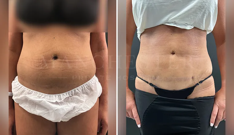 vaser liposuction before and after-2