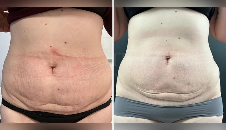 vaser liposuction before and after-3