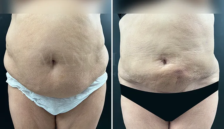 vaser liposuction before and after-4