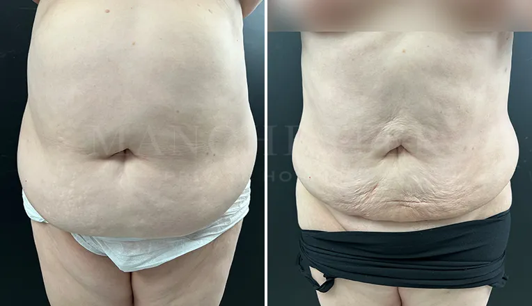 vaser liposuction before and after-5