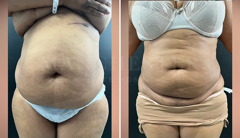 vaser liposuction before and after-6