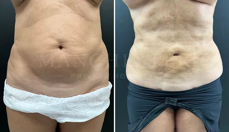 vaser liposuction before and after-9