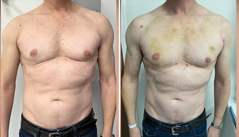 vaser liposuction before and after men-1