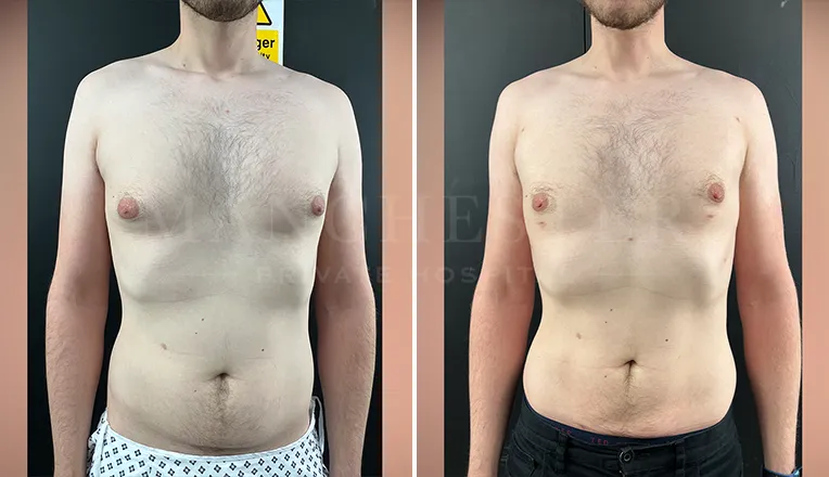 vaser liposuction before and after men-2