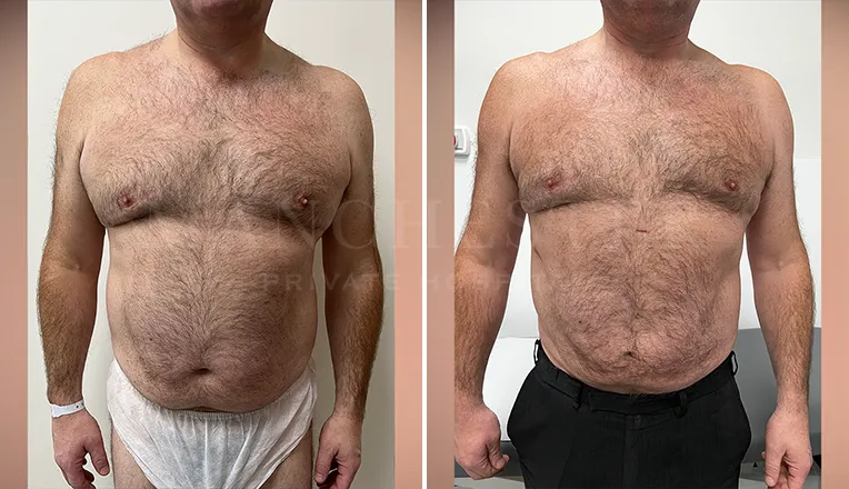 vaser liposuction before and after men-3
