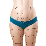 Vaser Liposuction – The Best Way to Remove Excess Fat in Minimally Invasive Procedure